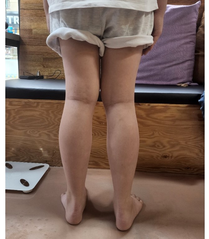 T교정 전 휜다리 뒷모습